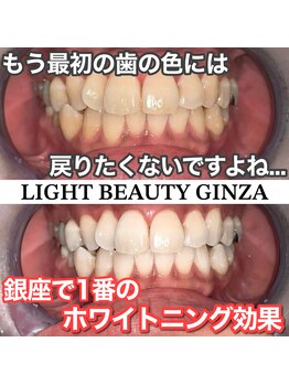 ライトビューティー 銀座店(LightBeauty)/東銀座　ホワイトニング症例写真