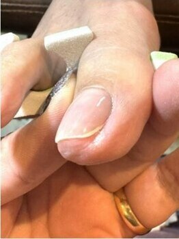 ナナ 名護店(NANA)の写真/≪悩みから開放、隠すから見せるに≫巻き爪など爪のお悩みは早めに解決！フットネイルと角質ケアを同時に♪