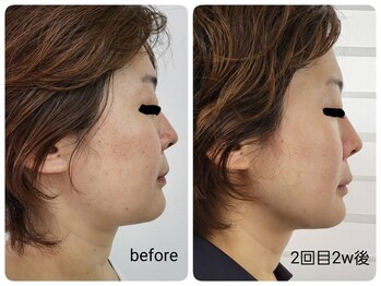 レゾン 京橋店/最新！韓国美容☆レモンボトル