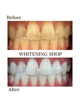 ホワイトニングショップ 岸和田店/お客様のBefore  After