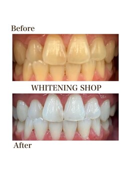 ホワイトニングショップ 岸和田店/お客様のBefore  After