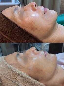 アースコアフュールボーテ ひたち野うしく店(EARTH coiffure beaute)/光フェイシャル