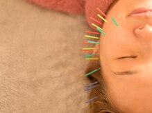 アロエベル(aloe Belle)/美容鍼