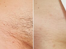 レネットサロン(Reinette Salon)/VIOトリプル脱毛
