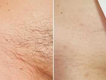 レネットサロン(Reinette Salon)/VIOトリプル脱毛