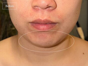 キュレイテッドスキン(CURATED SKIN)/レモンボトル/脂肪分解美容液