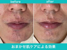 ミスターアンクール 鹿児島(Mr.uncoeur)/おまかせ肌ケア