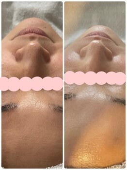 サロン シー(salon shhh...)/トーンアップ&毛穴改善