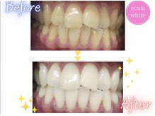 エクシアホワイトニング 西条店/ビフォーアフター