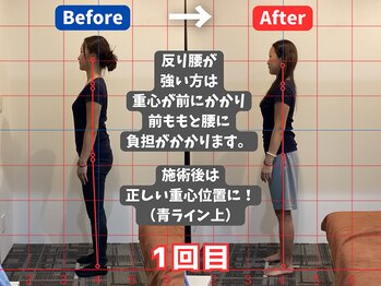 薮下整体院 札幌円山店/20代女性 反り腰による腰痛の方