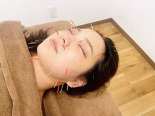 美容鍼で小顔&リフトUP効果◎[肩こり,腰痛,整体,鍼灸]
