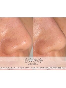 毛穴ケアをしたい