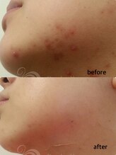 セレネ(SELENE)/フェイスラインニキビ