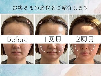 さくら鍼灸院 整骨院/美容鍼3