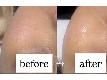 ルネ(Renee)/ハーブピーリング(1回の変化)