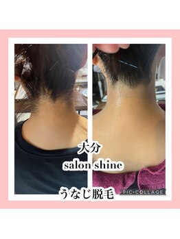 サロンシャイン(Salon Shine)/うなじ脱毛照射後