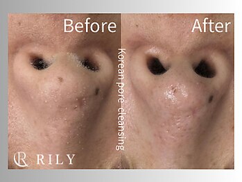 リリー(RILY)/【毛穴洗浄ビフォーアフター】
