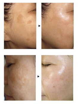 ラパス(Lapaz)/シミ改善プログラム