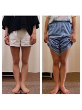 クシロ鍼灸整骨院/【O脚矯正】施術例