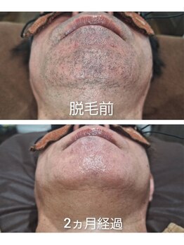 アカラ 読谷店(AKALA)/ヒゲ脱毛2か月経過