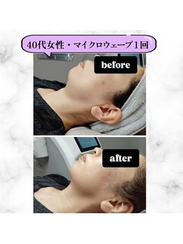 グランディールアン(GRANDIR UN)/たった20分で脱二重あご