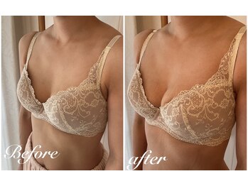 美バストアルファ(美bust α)/【バストアップ】症例