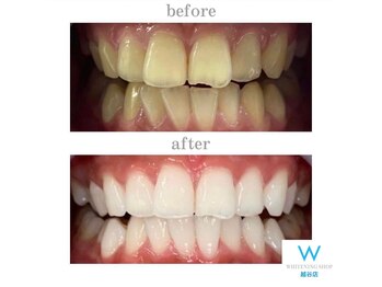 ホワイトニングショップ 越谷店/before&after美白ホワイトニング