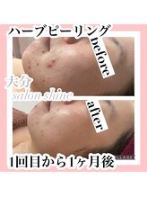 サロンシャイン(Salon Shine)/ハーブピーリング1回1か月後