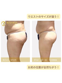 キングスサロン 熊本/三段腹の原因はインナーマッスル