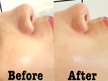 シード(SHE°)/ハーブピーリング