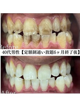 ホワイト 福岡天神店(WHITE)/ホワイトニングビフォーアフター