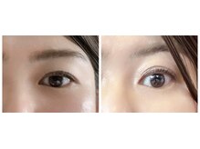 ルキア(LUKIA)/小顔【目元集中】施術１回