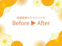 ホワイトニングセンター 長野駅前店/【ビフォーアフター♪】