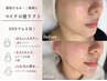 【再来】マイクロ波リフト80KJ 〈脂肪分解/ボリュームダウン〉￥15,000