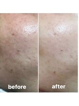 エムズビューティー(M’s Beauty)/カーボンピーリング