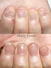 マリーロール 梅田店(Marie Laure)/自爪育成/深爪矯正/ネイルケア