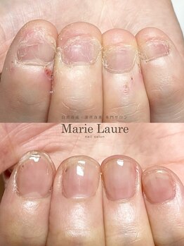 マリーロール 梅田店(Marie Laure)/自爪育成/深爪矯正/ネイルケア