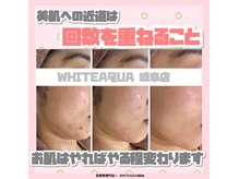 ホワイトアクア 岐阜店(WHITE AQUA)/ハーブピーリング/ニキビ/岐阜