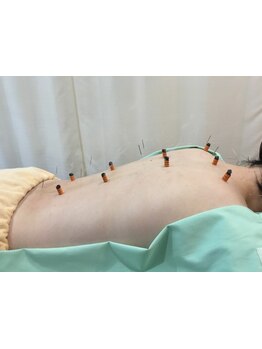 鍼灸施術を受けたい