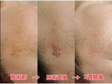 クイーン(QUEEN)/シミケアのビフォーアフター