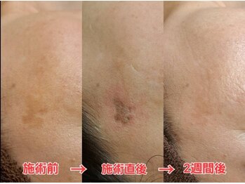 クイーン(QUEEN)/シミケアのビフォーアフター