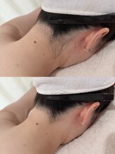 ナビ ビューティー(NABI Beauty)/【うなじ脱毛】