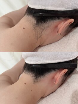 ナビ ビューティー(NABI Beauty)/【うなじ脱毛】