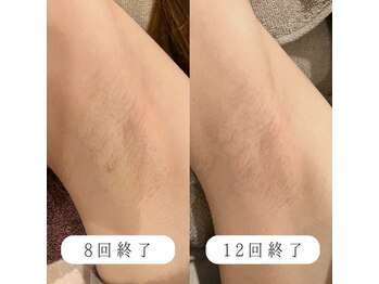 ニコリー(NICOLY)/わき脱毛【12回】