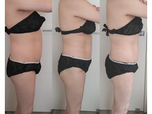 フェリーチェ(felice)/施術例／ウエスト引き締め