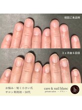 ブラン(blanc)/自爪育成３ケ月集中ケアコース