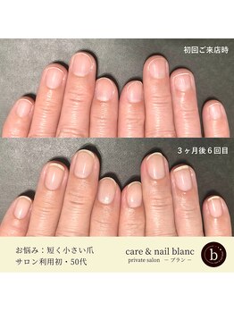 ブラン(blanc)/自爪育成３ケ月集中ケアコース