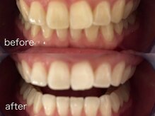 セルフホワイトニング／8分照射×2／デート／ブライダル