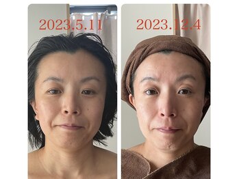 ノレーヴ(NOS REVES)/小顔