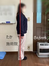 たか施術院/首 肩こり 美姿勢 初回施術前